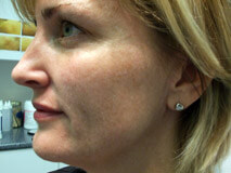 Before IPL Treatment