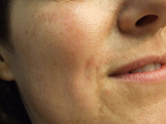 Post Vein Removal