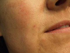 Pre Vein Removal