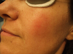 Post Spider Hemangioma