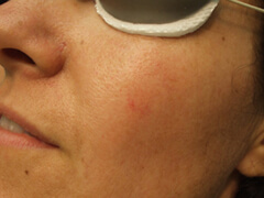 Pre Spider Hemangioma