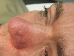 Post Vascular Nose Treatment