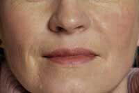 After Dermal Fillers