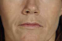 After Dermal Fillers