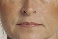 Before Lip Injections