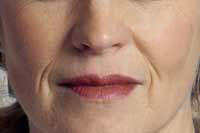 Before Dermal Fillers