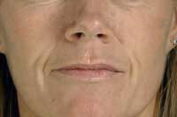 Before Dermal Fillers