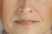 Before Lip Injections