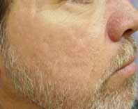 After acial Rejuvenation