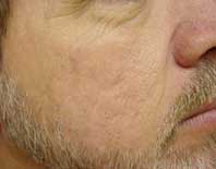 After Facial Rejuvenation