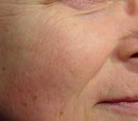 After Excessive Redness Treatment
