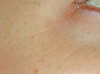 After Redness