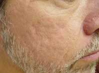 Before Laser Treatment