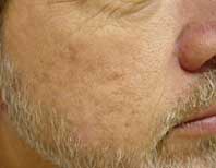 Before Facial Rejuvenation