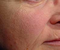 Before Excessive Redness Treatment
