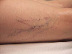 Before Vascular Treatment
